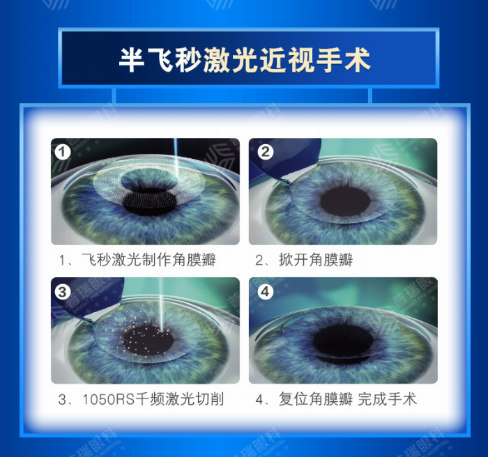 暑期摘镜总动员 |普瑞眼科专家解读AI+千频优视飞秒近视手术